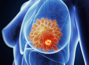 Cảnh báo 6 dấu hiệu ung thư vú chị em nên cẩn trọng